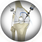 Knee Arthroscopy